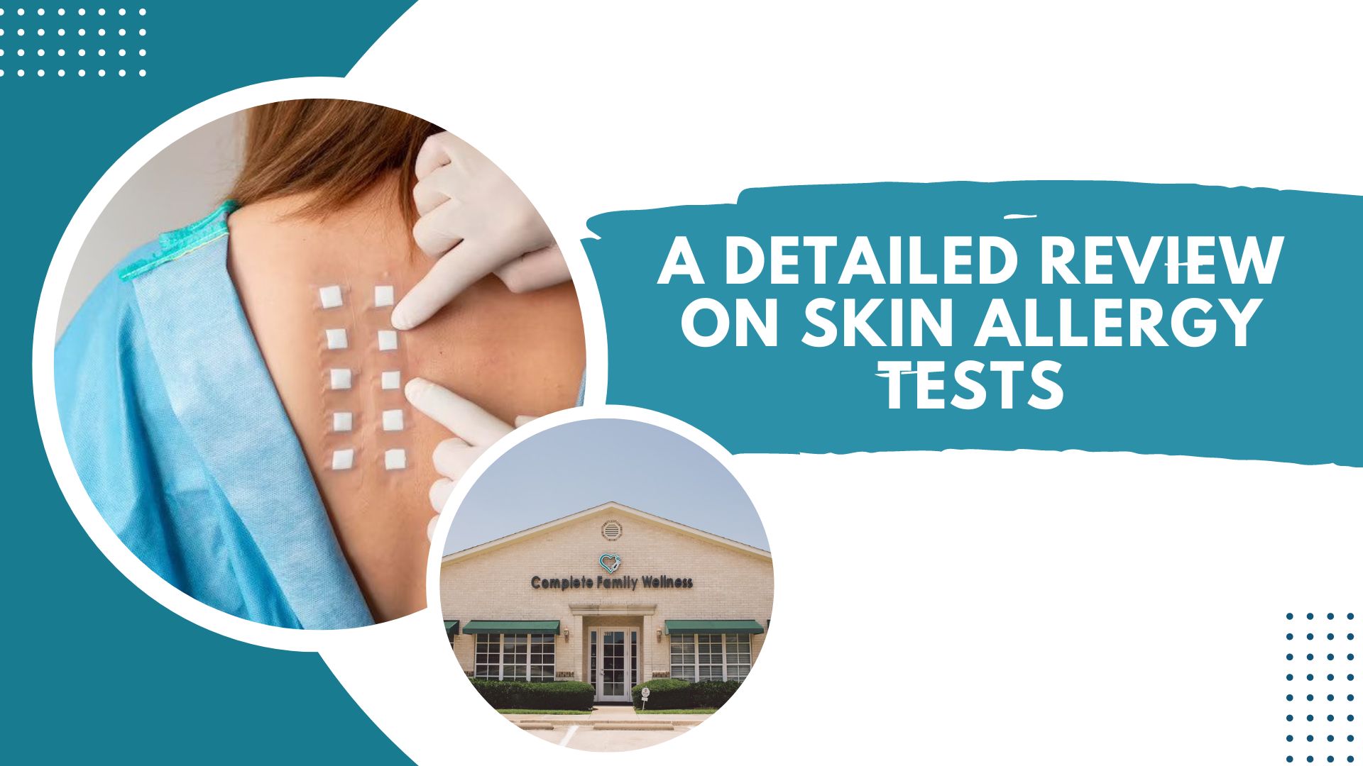 A Detailed Review On Skin Allergy Tests- Skin Patch Test For Layman
