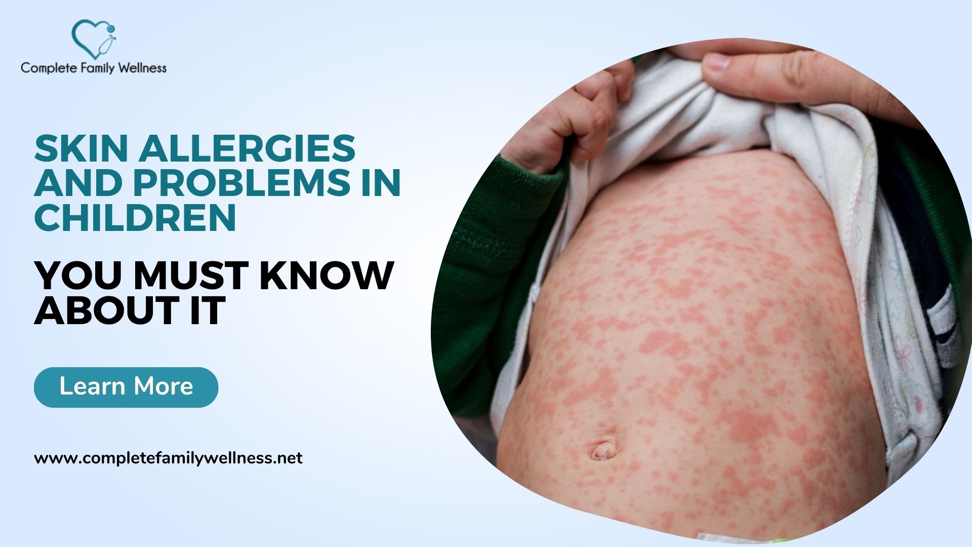 Skin Allergies And Problems In Children – Things You Must Know About