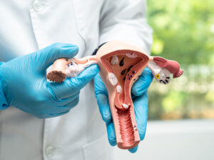 Doctor holding anatomy model of uterus to illustrate discussing PCOS vs. endometriosis